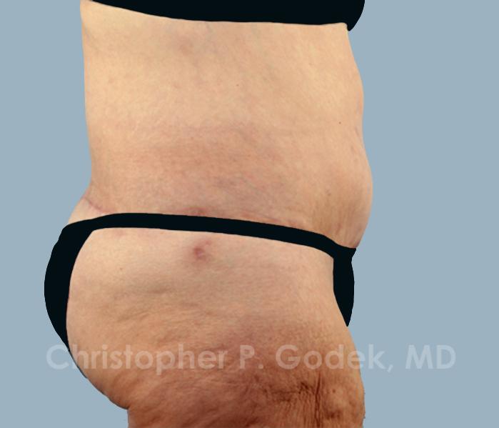 Tummy Tuck Before & After Image