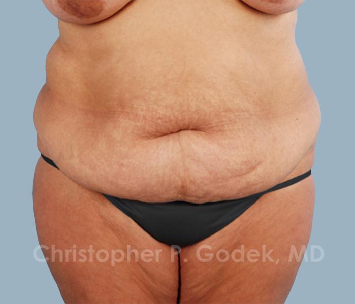 Tummy Tuck Before & After Image