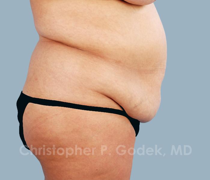 Tummy Tuck Before & After Image