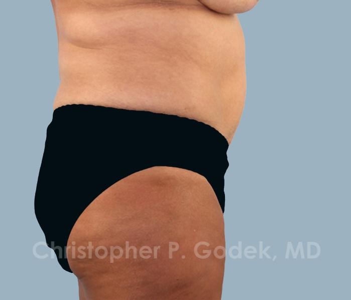 Tummy Tuck Before & After Image