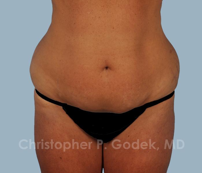 Tummy Tuck Before & After Image
