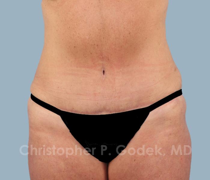 Tummy Tuck Before & After Image