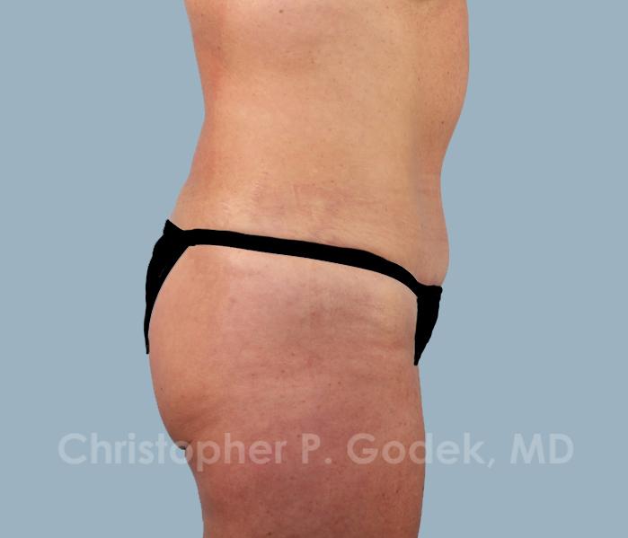 Tummy Tuck Before & After Image