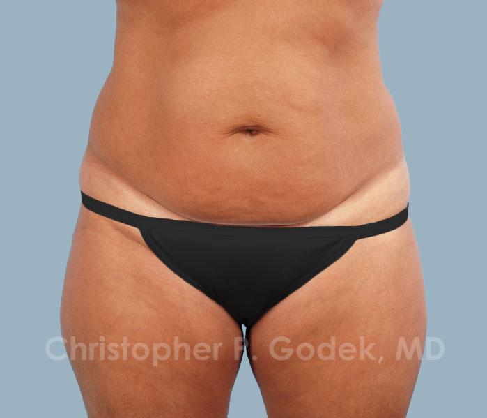 Tummy Tuck Before & After Image