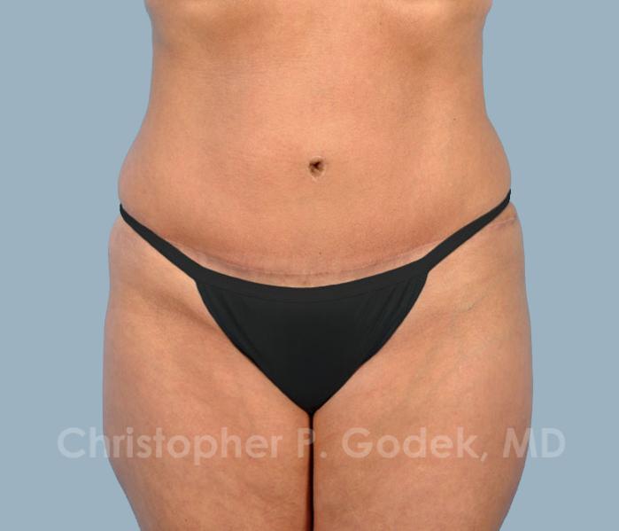 Tummy Tuck Before & After Image