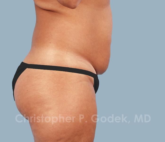 Tummy Tuck Before & After Image