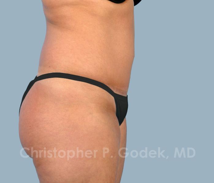Tummy Tuck Before & After Image