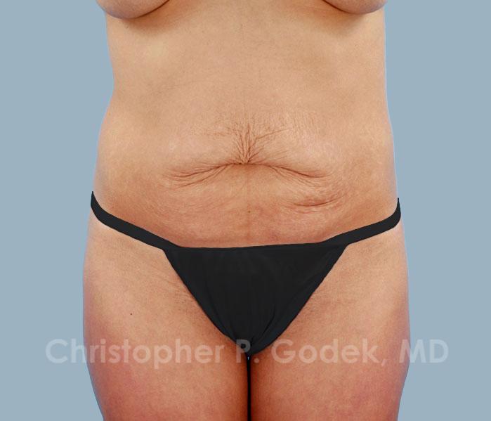 Tummy Tuck Before & After Image