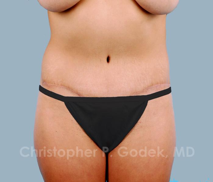 Tummy Tuck Before & After Image