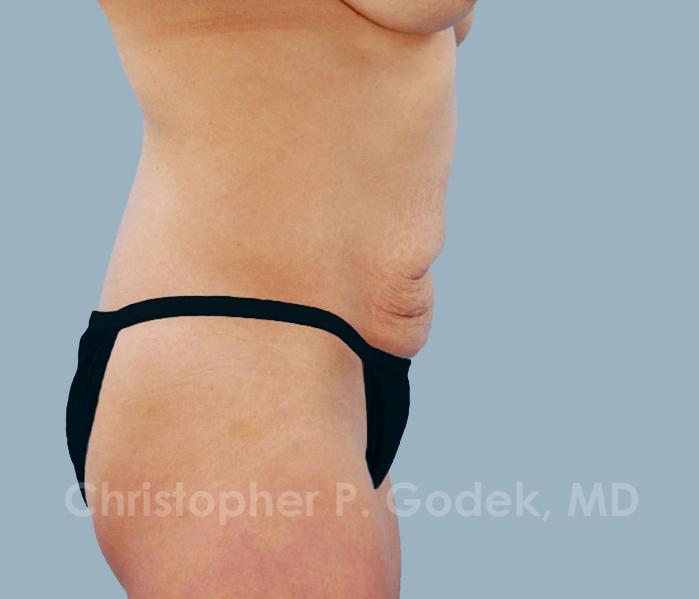Tummy Tuck Before & After Image