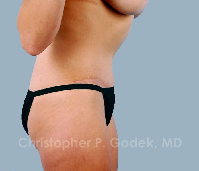 Tummy Tuck Before & After Image