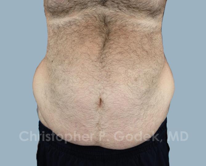 Tummy Tuck Before & After Image