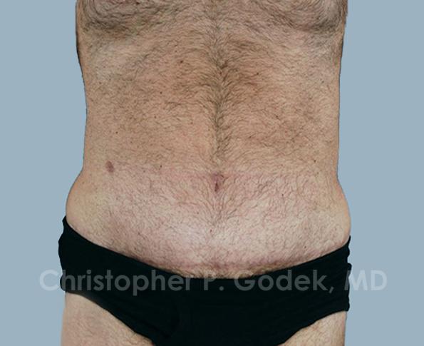 Tummy Tuck Before & After Image