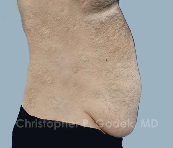 Tummy Tuck Before & After Image