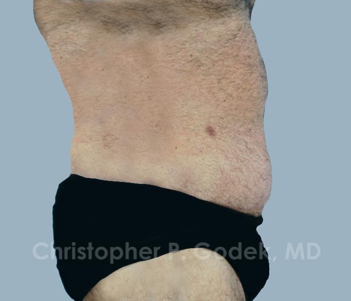 Tummy Tuck Before & After Image
