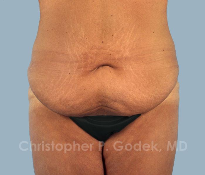 Tummy Tuck Before & After Image