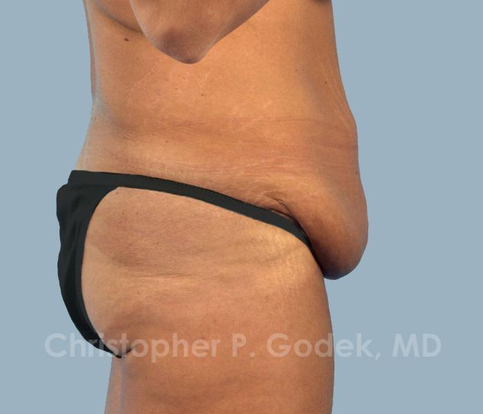 Tummy Tuck Before & After Image