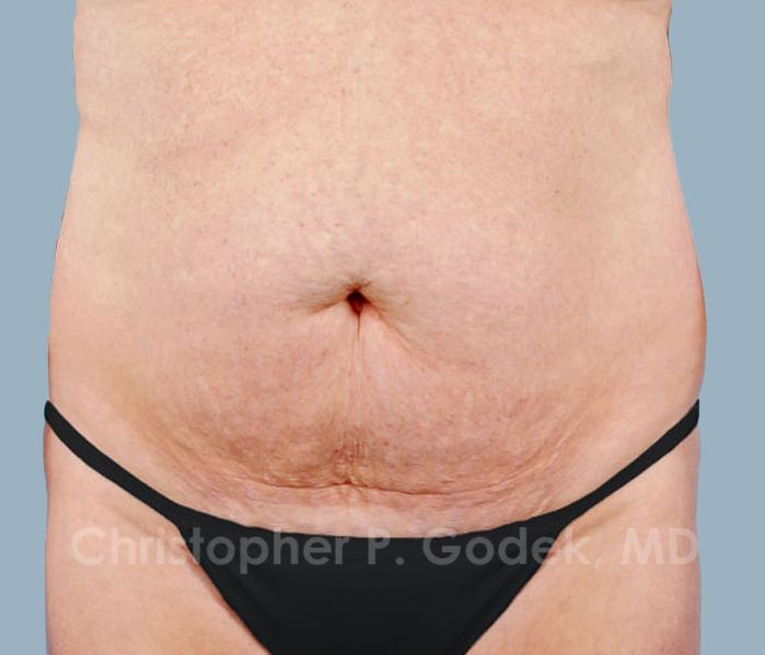Tummy Tuck Before & After Image