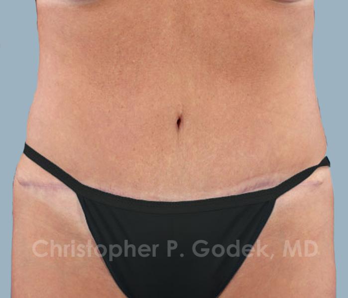 Tummy Tuck Before & After Image