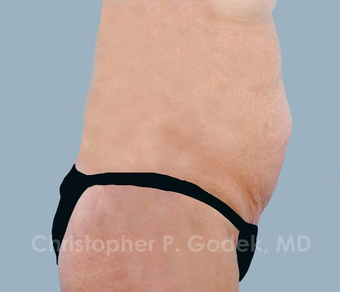 Tummy Tuck Before & After Image