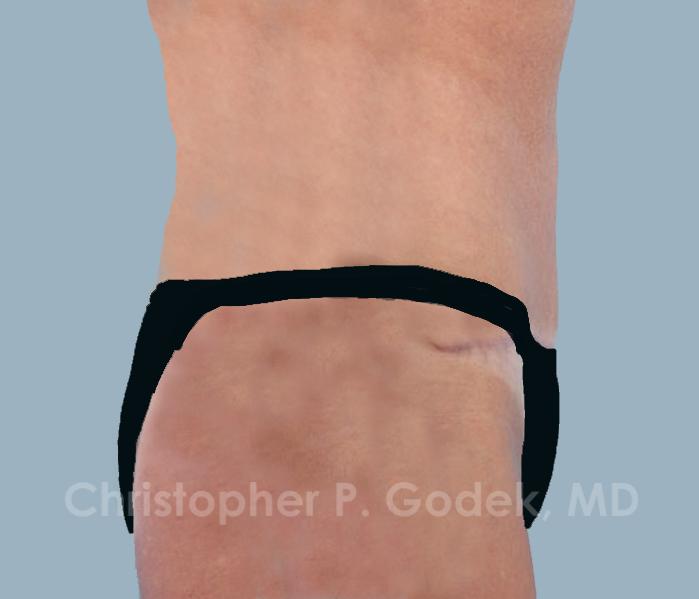 Tummy Tuck Before & After Image