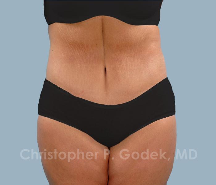 Tummy Tuck Before & After Image