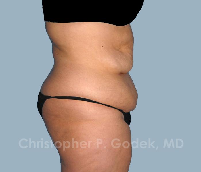 Tummy Tuck Before & After Image