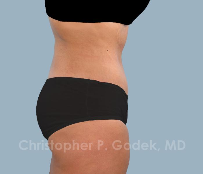 Tummy Tuck Before & After Image