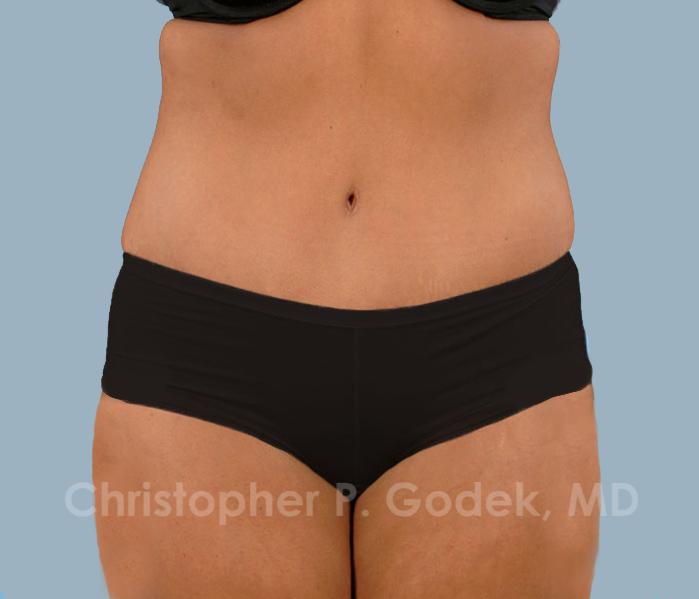 Tummy Tuck Before & After Image
