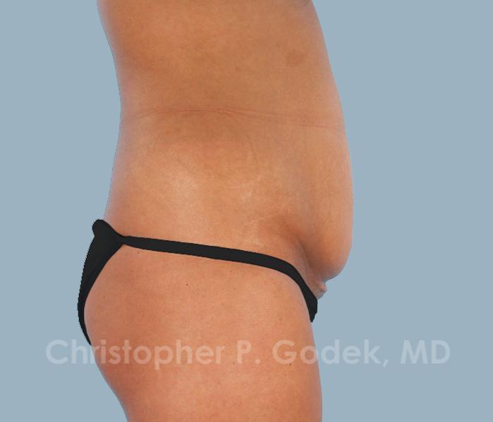 Tummy Tuck Before & After Image