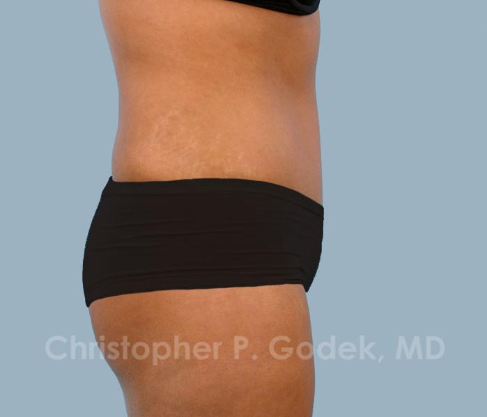 Tummy Tuck Before & After Image