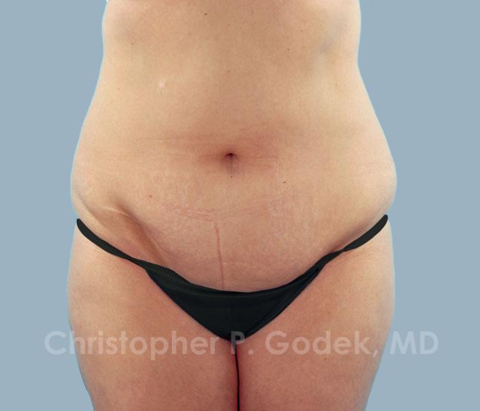 Tummy Tuck Before & After Image