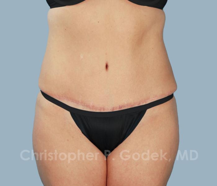 Tummy Tuck Before & After Image