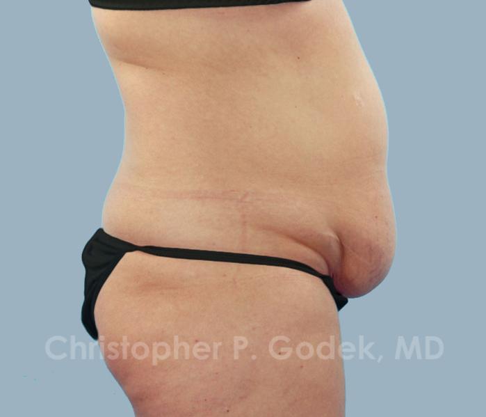 Tummy Tuck Before & After Image