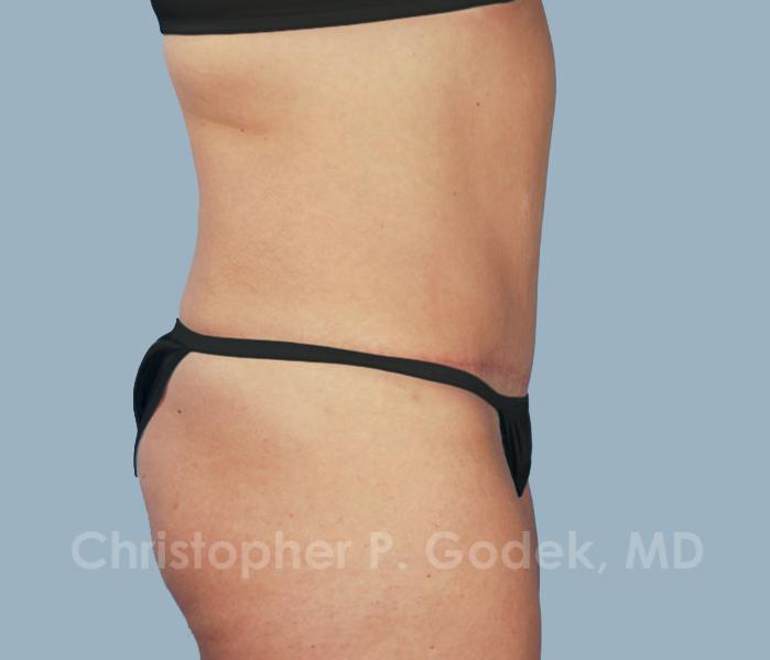Tummy Tuck Before & After Image