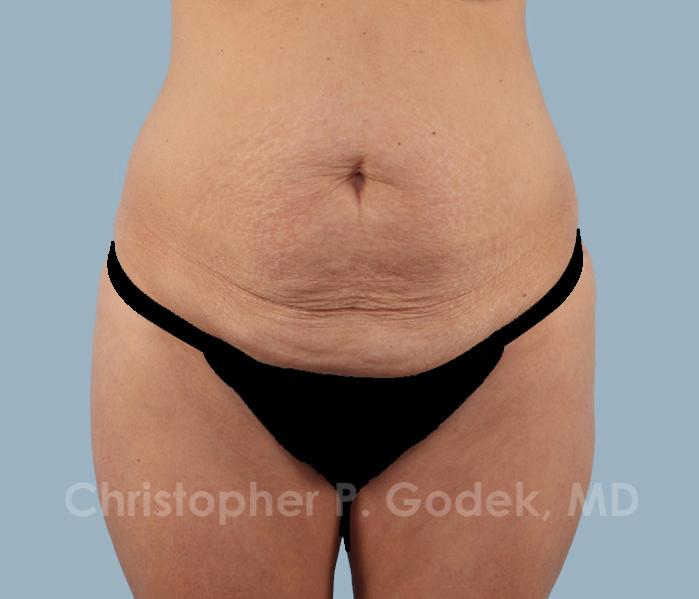 Tummy Tuck Before & After Image