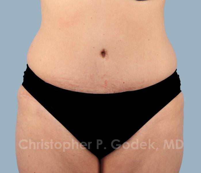 Tummy Tuck Before & After Image