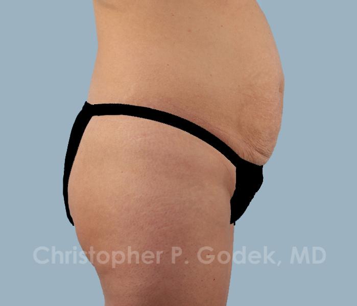 Tummy Tuck Before & After Image