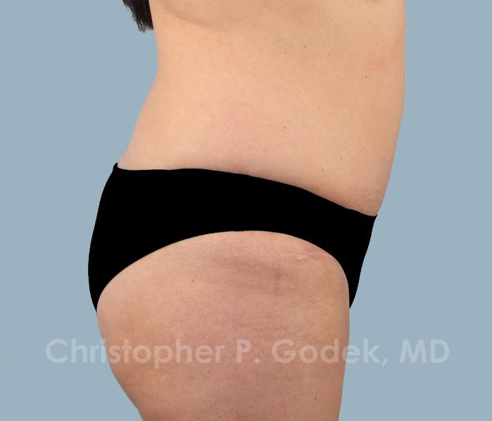 Tummy Tuck Before & After Image