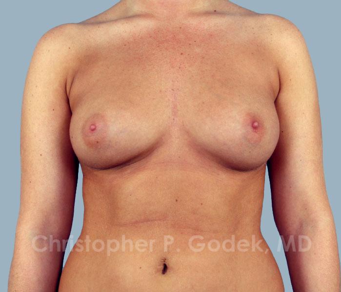 Breast Augmentation  Before & After Image