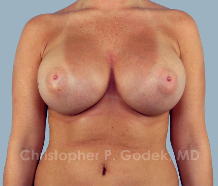 Breast Augmentation  Before & After Image