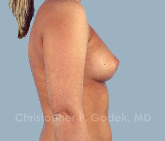 Breast Augmentation  Before & After Image