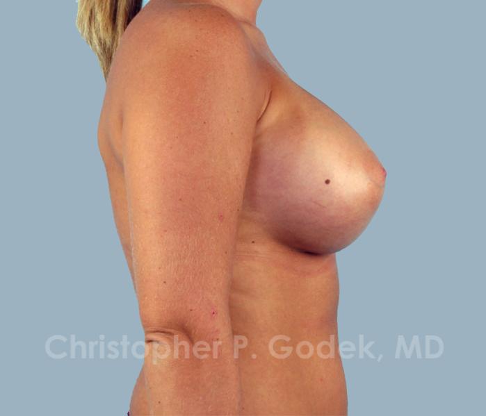 Breast Augmentation  Before & After Image