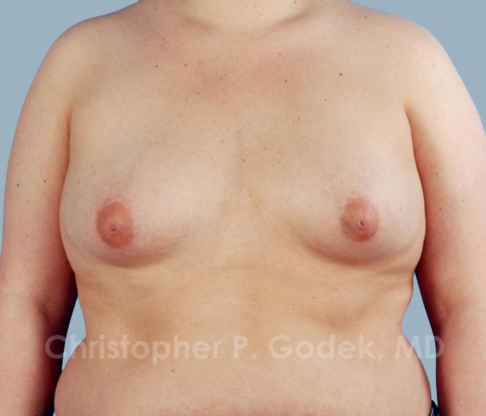 Breast Augmentation  Before & After Image