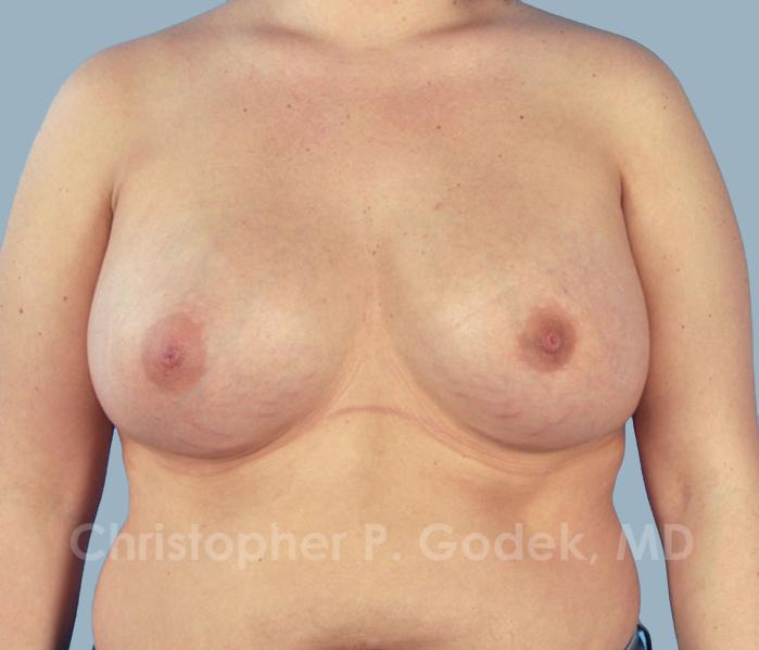 Breast Augmentation  Before & After Image