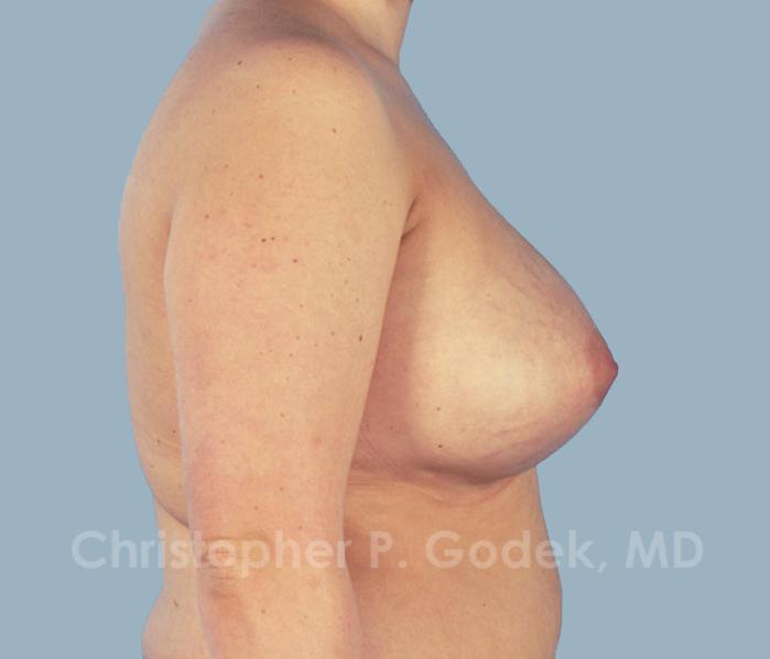 Breast Augmentation  Before & After Image