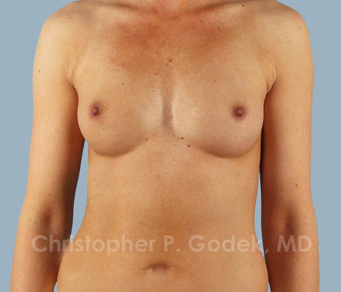 Breast Augmentation  Before & After Image