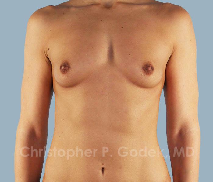 Breast Augmentation  Before & After Image