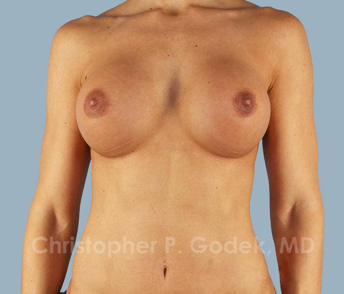 Breast Augmentation  Before & After Image