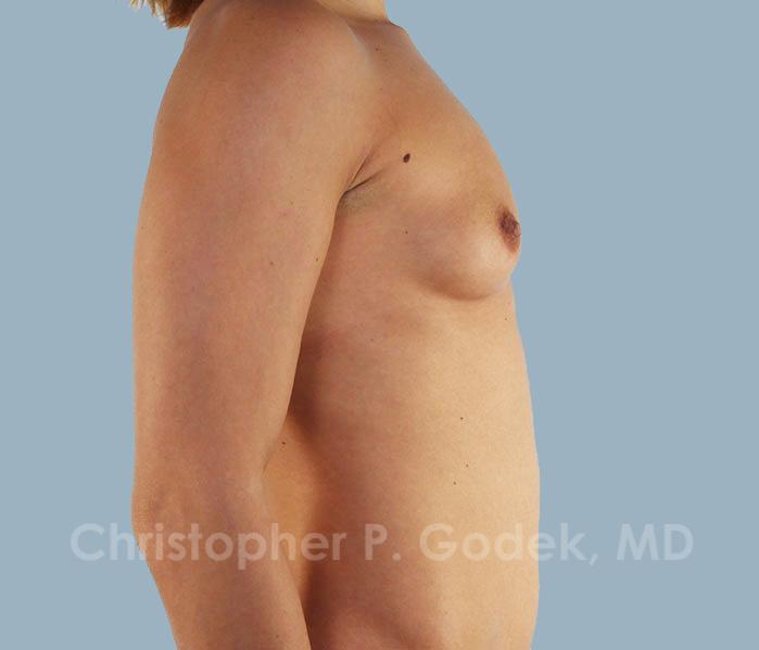 Breast Augmentation  Before & After Image